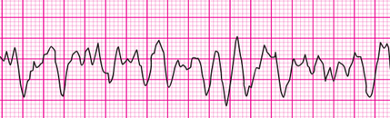 kammerflimmern im EKG